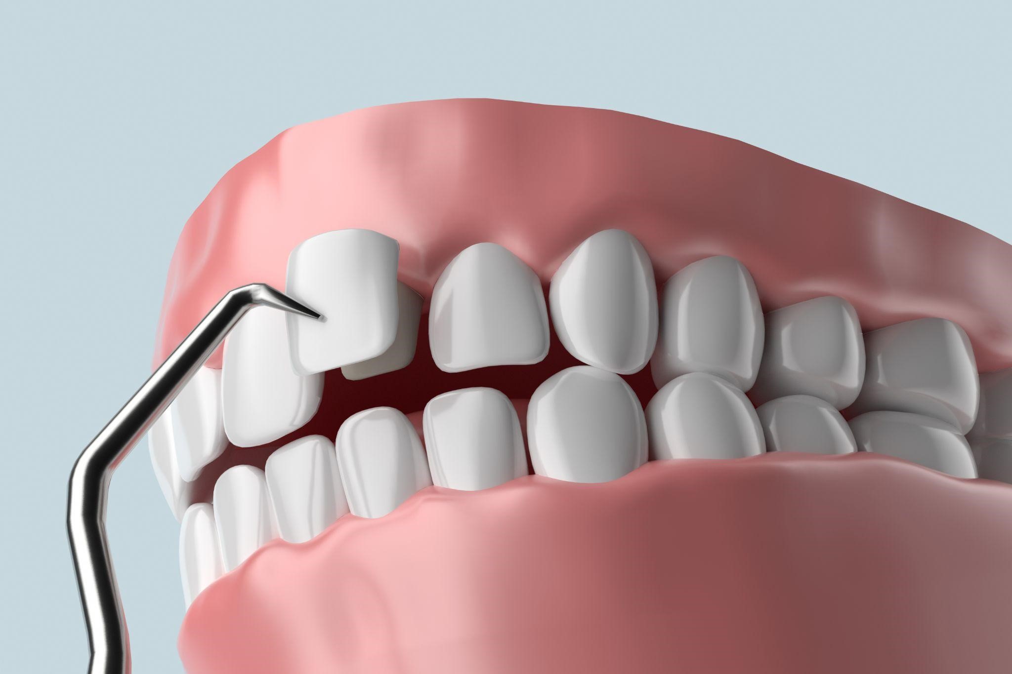 Dental Veneers Dental Veneers